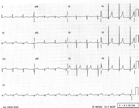 A Right­sided 12­lead Electrocardiogram Shows Normal Axis And Normal
