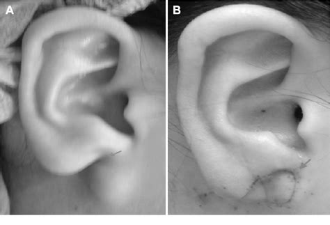 Figure 2 From Postauricular Flap Based On Dermal Pedicle For