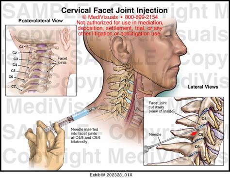 Cervical Facet Joint Injection Medical Illustration Medivisuals Uctd