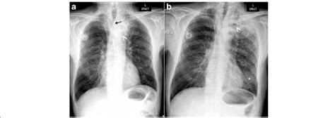 A Initial Chest X Ray Reveals An Apical Left Lung Partially Excavated