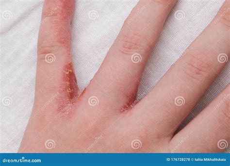 Child Hand Witn Eczema Atopic Dermatitis Between Fingers Stock Photo