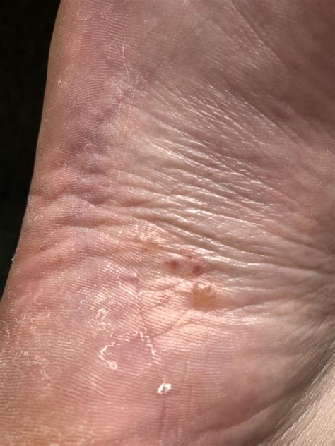 Red Spots On Soles Of Feet What Causes Red Spots On The Feet Other