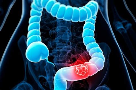 colon cancer types stages diagnosis treatment and prevention