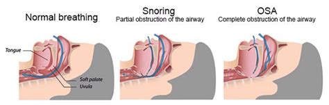 base of tongue reduction gno snoring and sinus