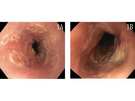 The most common cause is acid from the stomach. Infectious esophagitis in the immunosuppressed: Candida ...