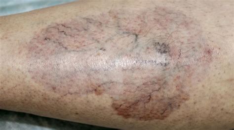 Type 2 Diabetes And Skin Pictures Dermopathy Infections And More