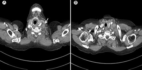 Chest Ct Demonstrated Multiple Enlarged Lymph Nodes In The Left Lower