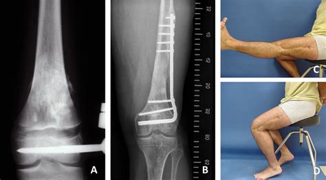 A Patient With Distal Femur Osteosarcoma Treated With Epiphysiolysis