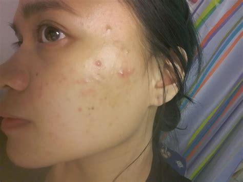 Acne Routine Help With Lots Of Texture And Regular Breakouts Pics