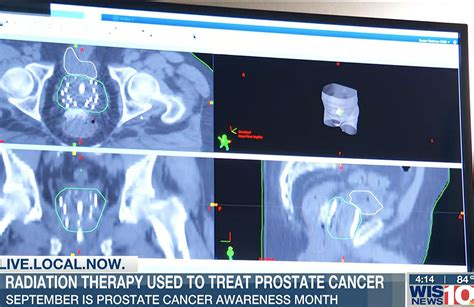 Brachytherapy External Beam Radiation Prostate Cancer The Best