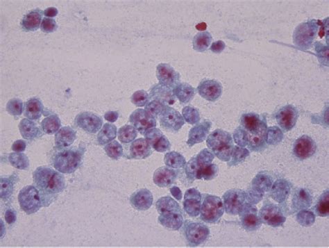 Tumor Cells Have Round Nuclei Centrally Located Prominent Nucleoli