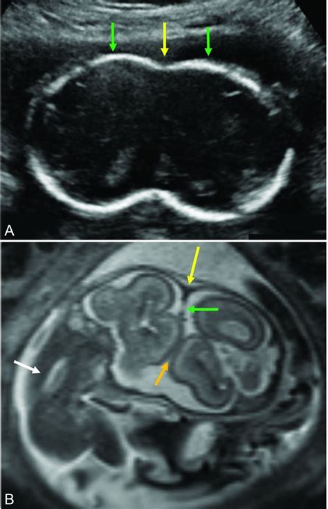 Preoperative Evaluation Of Craniopagus Twins Anatomy Imaging