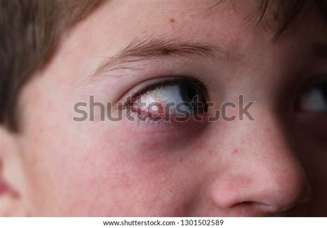 Red Eye Child Conjunctivitis Eye Measles Stock Photo Edit Now 1301502589