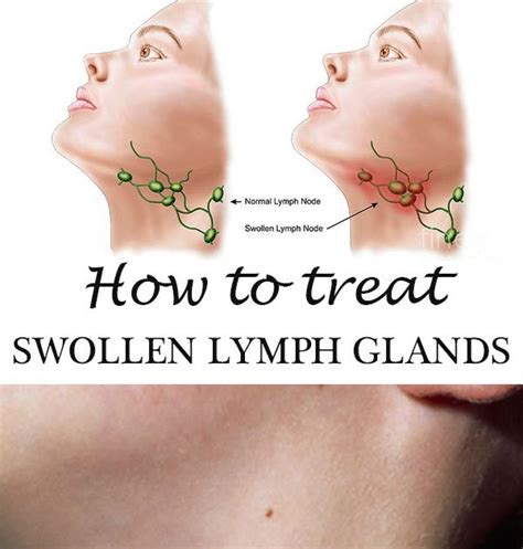 How To Treat Swollen Lymph Glands Beauty Enhancers