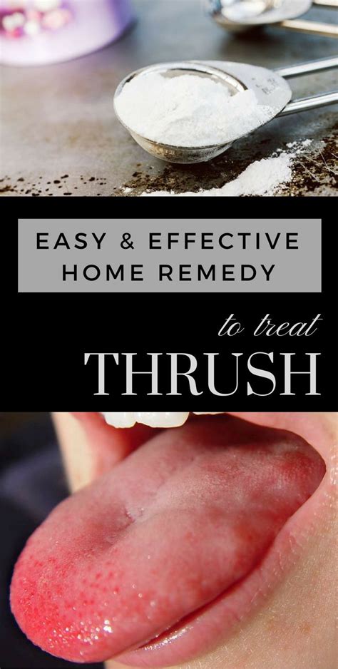 Easy And Effective Home Remedy To Treat Thrush Home Remedies Remedies