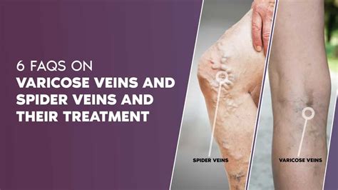 What Causes Varicose Veins Vascular Interventions
