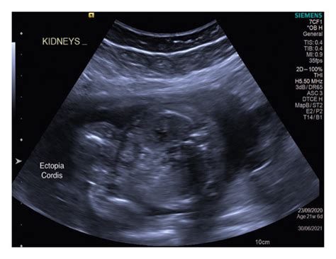 Ultrasound Image Showing Both The Kidneys And Ectopia Cordis