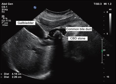 Ultrasound Showing Common Bile Duct Dilated 228×419 Cm With A 22