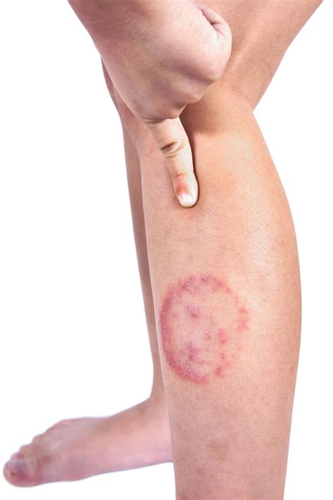 Ringworm Under Fungal Infections Istock 1169313197 Copy Apotheco
