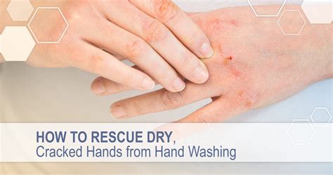 Home Remedies For Dry Hands Apderm