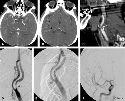 Ct Angiography And Stroke Barrow