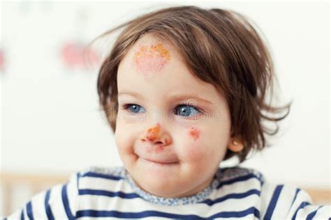 Baby With Bruises Stock Image Image Of Trauma Injured 44372671