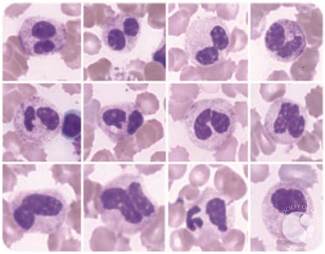 Dysplastic Neutrophils In The Bone Marrow Of A Shwachman Diamond