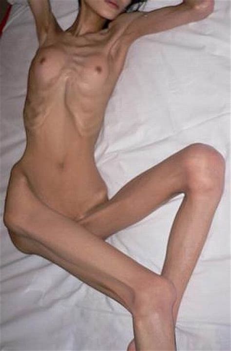 Nude Anorexic Girl