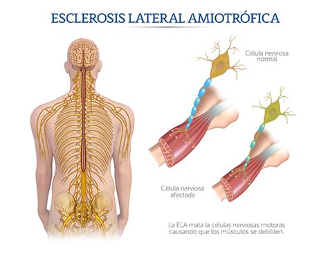 esclerosis lateral amiotrófica tratamiento trabajo desde la fisioterapia en la esclerosis