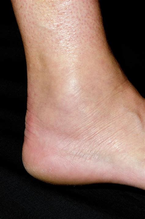Sprained Ankle Photograph By Dr P Marazzi Science Photo Library