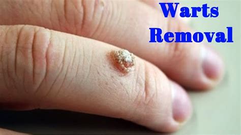 How To Get Rid Of A Wart In 1 Day Natural Wart Removal How To