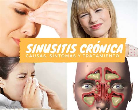 Sinusitis Crónica La Guía De Las Vitaminas