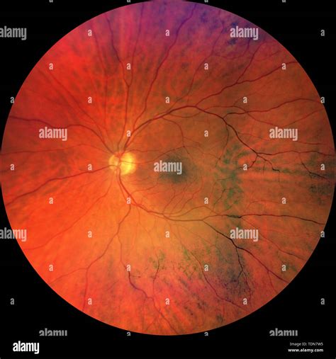 Fundus Eye Hi Res Stock Photography And Images Alamy