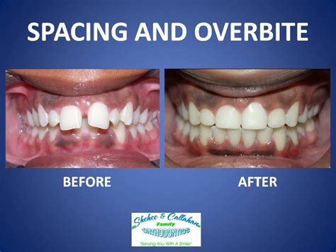 4 Teeth Extraction For Braces Before And After