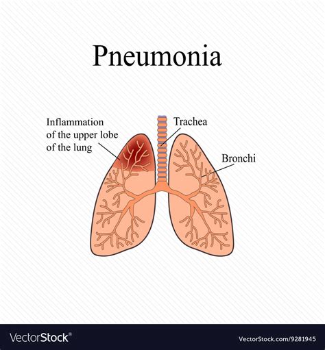 Pneumonia The Anatomical Structure Of The Human Vector Image