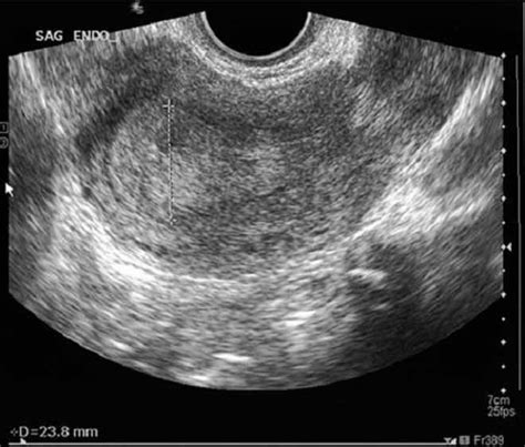 Endometrial Thickness Predicts Intrauterine Pregnancy In Patients With