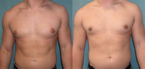 Gynecomastia Surgery Abroad Low Cost Health Travel Guide