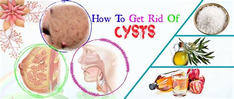 17 Best Ways How To Get Rid Of Cysts In Breast On Neck Or Face
