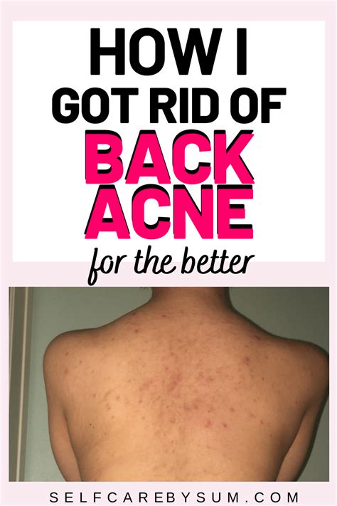 How To Get Rid Of Back Acne For Better Sbs Acne Wash Back Acne