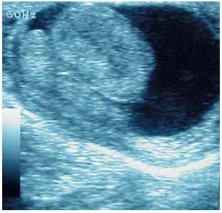 Infarto hemorrágico testicular en neonato presentación de un caso