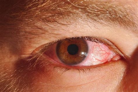 How To Get Rid Of Red Eyes Bloodshot 5 Ways Home Remedies