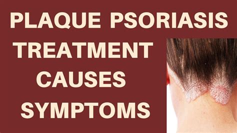 Plaque Psoriasis Treatment Causes And Symptoms Youtube