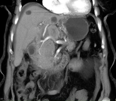 Gastric Lymphoma In Antrum With Extensive Adenopathy Stomach Case