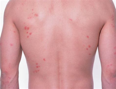 Bed Bug Bites On Persons Back Photograph By Science Photo Library