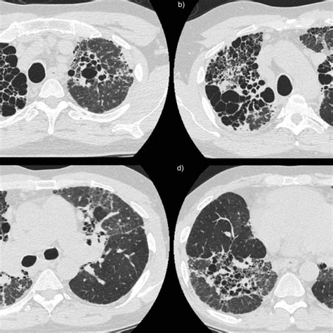 Computed Tomography CT Images A D CT Scan Of The Chest Showing