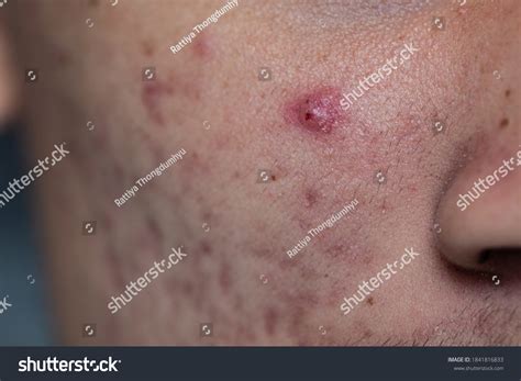 Backgrounds Lesions Skin Caused By Acne Stock Photo 1841816833