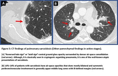 Ct Findings Of Pulmonary Sarcoidosis Other Parenchymal Findings In