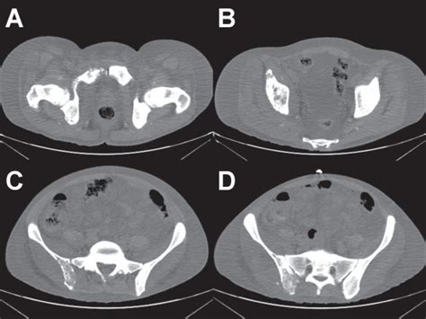 Computed Tomography Of Pelvis These Pre Treatment Ct Images