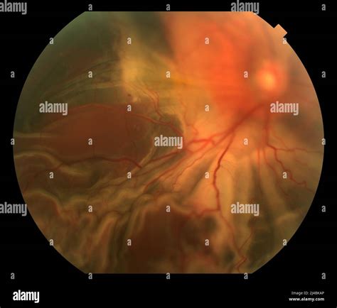 Retinal Haemorrhage And Detachment Fundoscopy Stock Photo Alamy