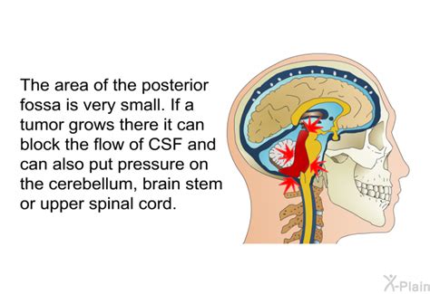 Posterior Fossa Craniotomy For Brain Tumors